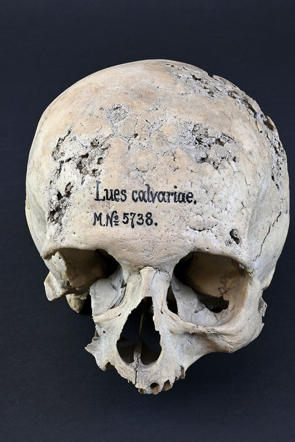  Syphillis, Schädelknochen © NHM Wien, C. Potter