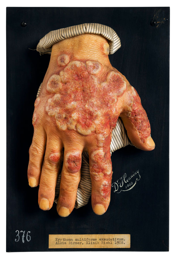  Rötungen und Entzündungen der Haut Erythema multiforme exsudativum MN.: 17.949 / Moulage, 1908 